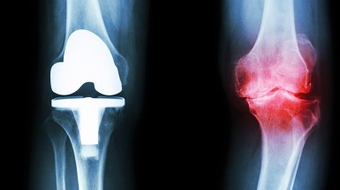 Groepsgesprek over knie-artrose voor het patients like me platform