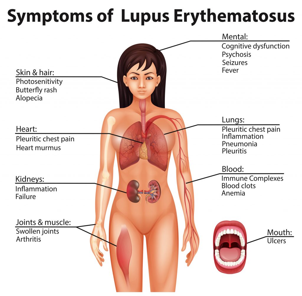 symptomen Lupus erythematodes klachten 