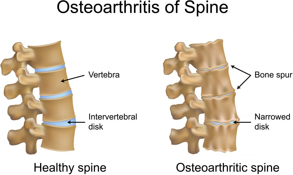 Afbeelding Osteoarthritis of spine
