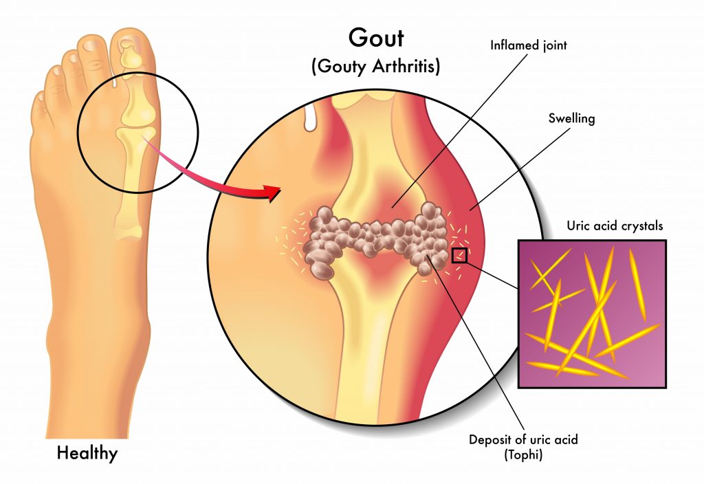 Jicht GOut Gouty Arthritis